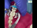 Rubber Dam Isolation of lower Molar