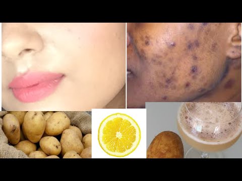 How to Remove BLACK SPOTS , DARK SPOTS & ACNE SCARS on face |ONLY in  days | TANUTALKS |