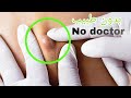 علاج الدمامل نهائيا بالبصل وصفة جد رائعة و مجربة | علاج الخراج | علاج الدمامل بدون رأس الدمل دمامل