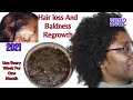 No hair will fall out again, this concoction speed my baldness growth, not a joke, go Alopecia free