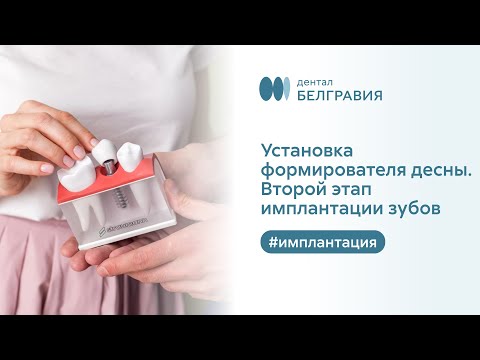 🦷​ Установка формирователя десны. Второй этап имплантации зубов