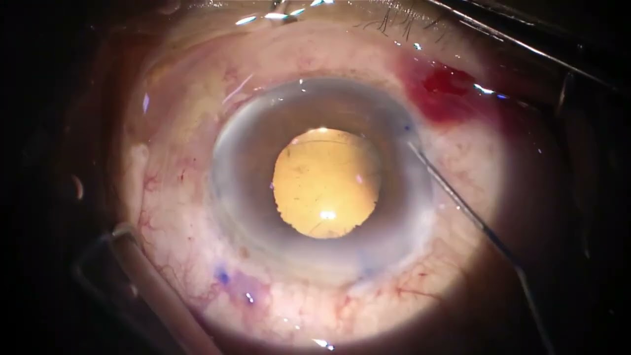 Ahmed Concept of Dual IOL fixation