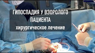 Hypospadie bei einem Erwachsenen. Operationsvideo