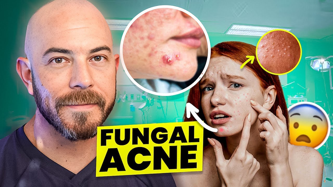 The Best Fungal Acne Treatments Of 2024 YouTube