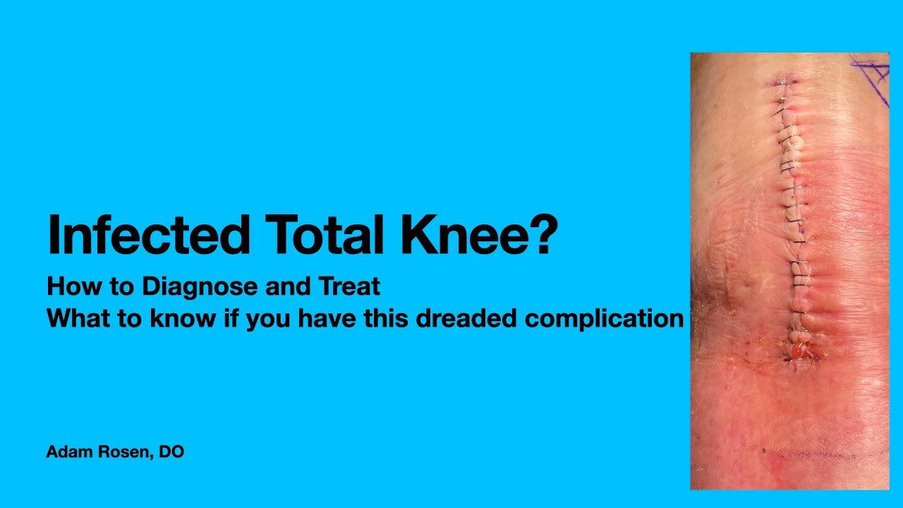 Infected Total Knee Replacement A Dreaded Complication What You Need