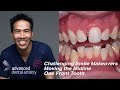 Difficult and Challenging Smile Makeover -  One Central Tooth - Moving the Midline