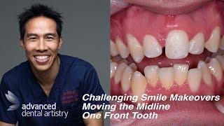 Difficult and Challenging Smile Makeover -  One Central Tooth - Moving the Midline