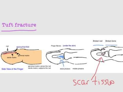 ਹੱਡੀਆਂ ਦੀਆਂ ਗੱਲਾਂ - ਫਿੰਗਰ ਟਿਪ ਅਤੇ ਨੇਲਬੈੱਡ ਦੀਆਂ ਸੱਟਾਂ (ਟਫਟ ਫ੍ਰੈਕਚਰ)
