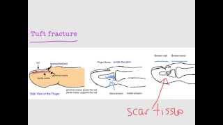 BoneTalks - FingerTip and Nailbed Injuries (Tuft Fracture)