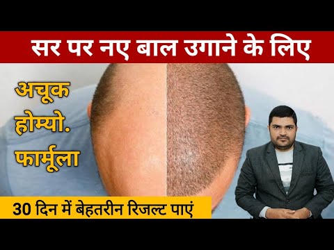 hair loss homeopathic medicine hair loss treatment in homeopathy - YouTube