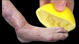 Leg pain, rheumatism, varicose veins, arthritis, headaches, joint pain. Mom's natural remedies