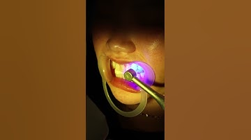 Quy trình gắn mắc cài niềng răng! #nhakhoakhacghi #niengrang