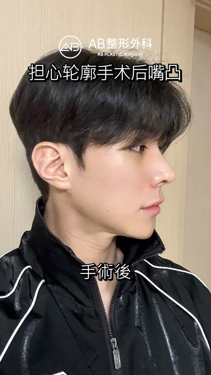 輪廓三件套＋嘴凸＋鼻整形，帥氣大變身✨ #Shorts