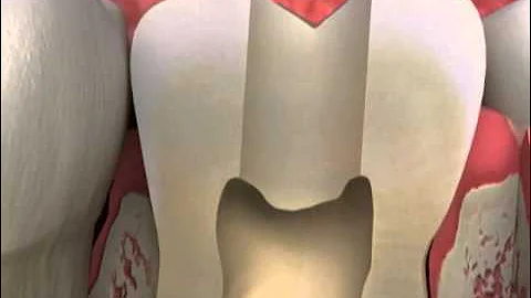 Crowns after Root Canal Therapy - Sample CAESY Video