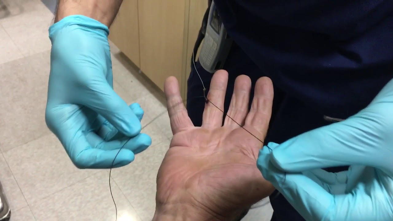 Fishhook removal using string method YouTube