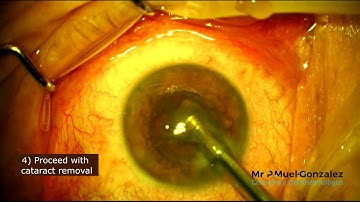 Dealing with a small/medium pupil and floppy iris during cataract surgery