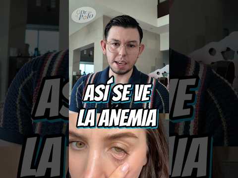 SINTOMAS de ANEMIA!!!