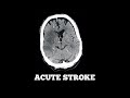 Acute Stroke Case Discussion