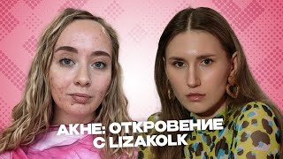 видео: Подкаст KrissMo АКНЕ: откровение с Lizakolk|Как принимать себя, вести инстаграм без фильтров КОНКУРС картинка: Подкаст KrissMo АКНЕ: откровение с Lizakolk|Как принимать себя, вести инстаграм без фильтров КОНКУРС