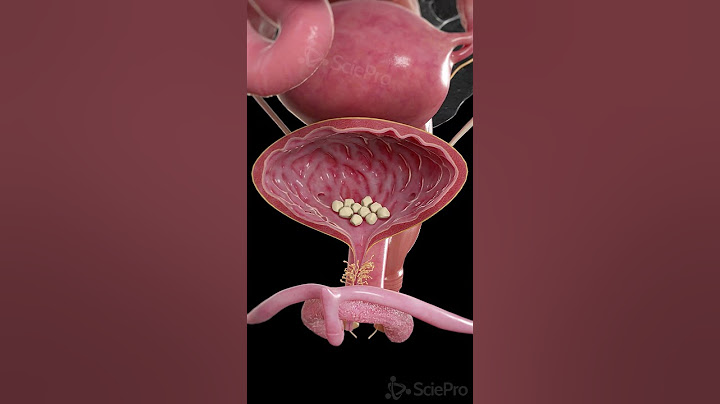 🪨 Bladder Stones: What You Need to Know 🪨 #anatomy