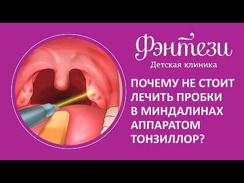 Видео: 4 способа удаления камней в миндалинах (тонзилолиты)