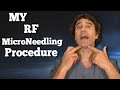 MY RF Microneedling RESULTS and EXPECTATIONS // Dr Rajani