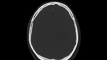 CT Brain Normal - Bone Window