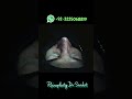 #DrSaadatUllah #NoseJobPakistan #RhinoplastyInPakistan #RhinoplastyExpert#viralvideo