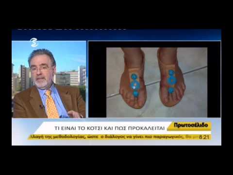 AMC | Δρ. Νίκος Γρανίτσας | Πώς να αντιμετωπίσετε το κότσι στο πόδι;