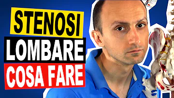 Cosa fare in caso di stenosi lombare?