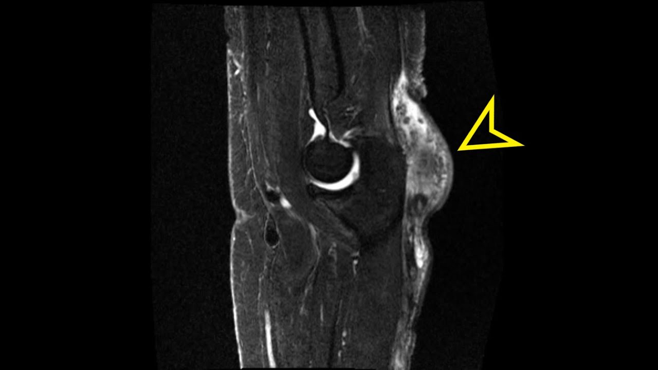 Elbow MRI Olecranon Bursitis YouTube elbow-mri-olecranon-bursitis-youtube