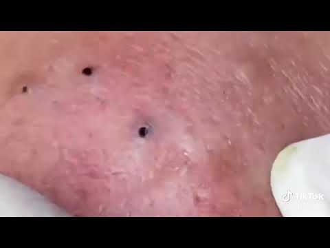 تنظيف حبوب وبثور الوجه راحة نفسية يرجى الاشتراك بالقناة