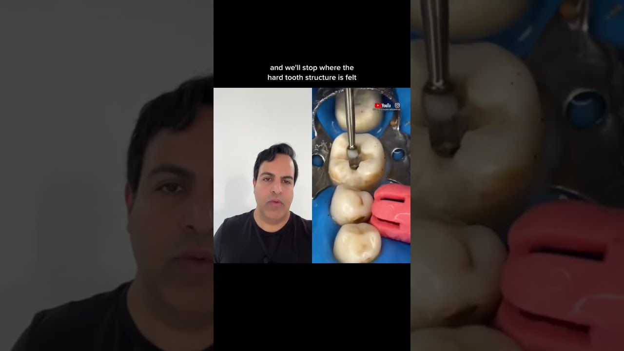 I got a hole on the top of my tooth. Can I fix it?🤯