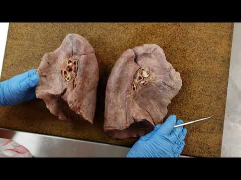 Video: Rozdíl Mezi Hilum A Root Of Lung