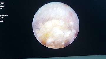 TÁN SỎI NIỆU QUẢN NỘI SOI.12/9/2019.TTUT.TS.BS.Duong Văn Trung☎0913534343.web:soithan.net.vn