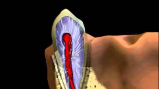 Devital Teeth