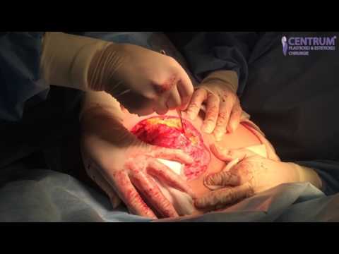Video: Zmenšenie Prsníkov - Chirurgické Zákroky, Dôvody, Recenzie