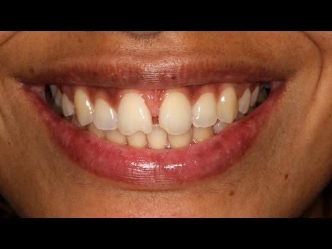 Rapper Siya’s Smile Makeover