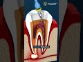 Painless Root Canal Treatment with Advanced Technology | Tooth Journey – Trusted Dental Care
