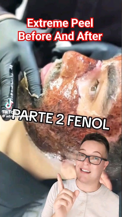 (TW!)😱 SHOCKING CHEMICAL PEEL - Phenol Peel Before and After #shorts