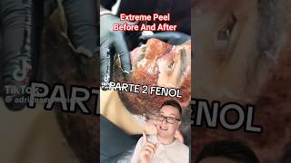 (TW!) SHOCKING CHEMICAL PEEL  Phenol Peel Before and After #shorts