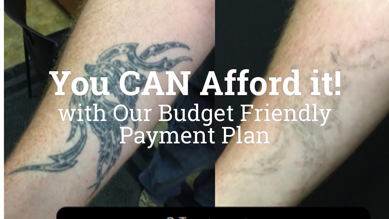 Cost of Expert Laser Tattoo Removal Lafayette Co 1080p 1 YouTube