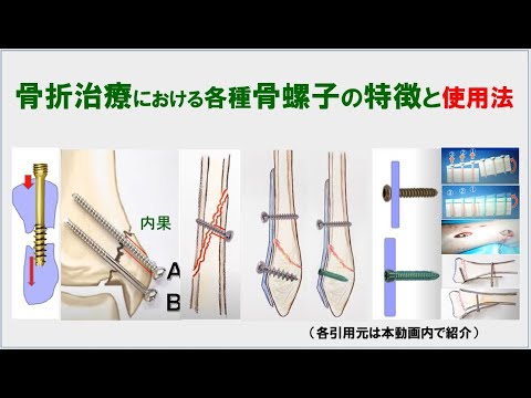 （18分26秒）骨折治療における各種骨螺子の特徴と使用方法