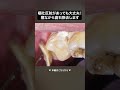 嘔吐反射があっても寝ながら歯石除去できます💤