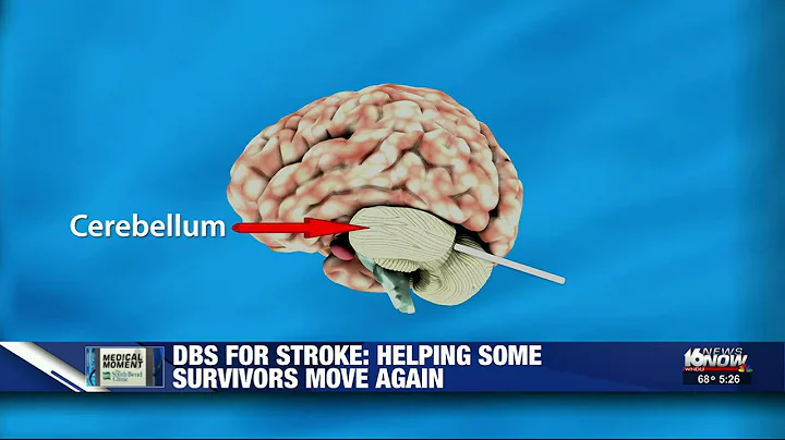 Medical Moment: Deep brain stimulation for stroke victims