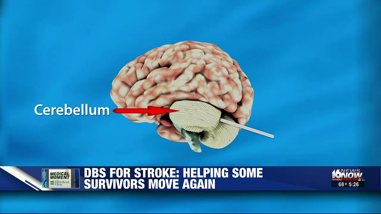 Medical Moment: Deep brain stimulation for stroke victims