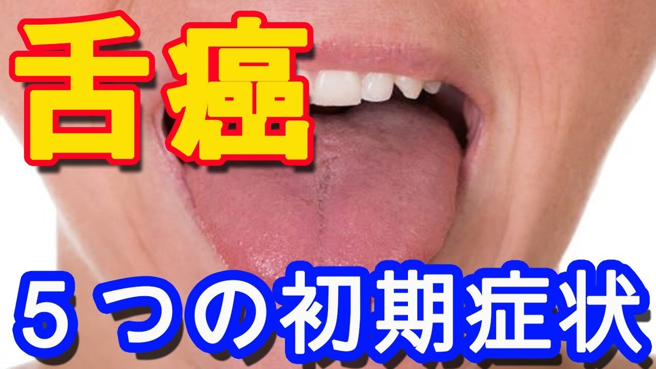 舌癌の 症状: 口腔癌 初期症状 しこり 写真 _ 舌癌 5つの初期症状 – JISMCS