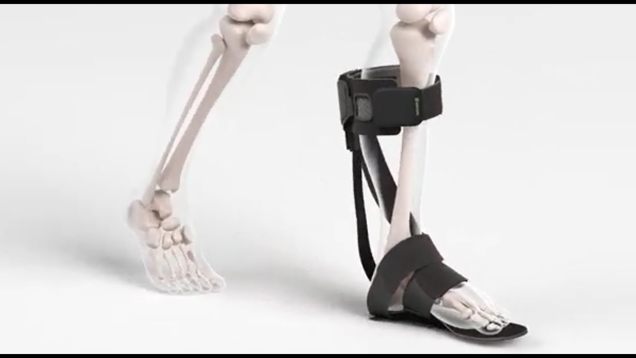 HelixBand: How it Works as a Foot Drop Solution for Frontal Plane Weaknesses