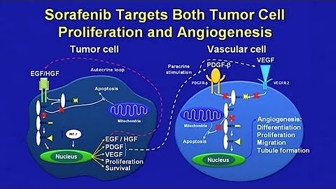 Hepatocellular Carcinoma - Molecular Approaches to Treatment - DayDayNews