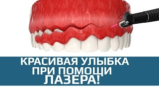 Хирургическая стоматология. Гингивэктомия. Подрезание десны лазером.(, 2017-03-16T15:09:43.000Z)